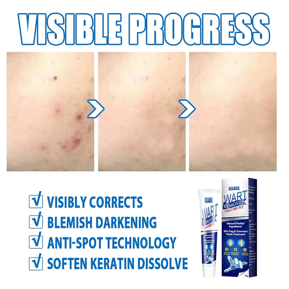 🌿 WartAway™ Herbal Removal Cream