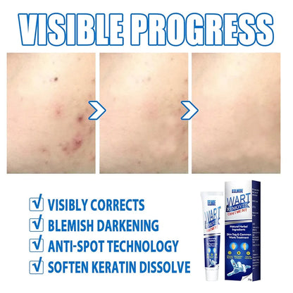 🌿 WartAway™ Herbal Removal Cream