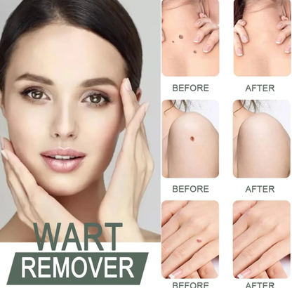 🌿 WartAway™ Herbal Removal Cream